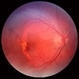 Choroidal Rupture through Fovea Choroidal Rupture through Fovea